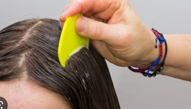 Lice Removal Boca – How To Get Rid Of Lice